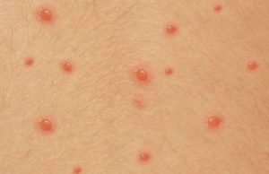 ചിക്കൻപോക്സിനെ സൂക്ഷിക്കണം:രോഗം വന്നവരും വരാത്തവരും അറിഞ്ഞിരിക്കേണ്ട കാര്യങ്ങൾ…