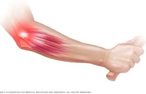 ടെന്നീസ് എല്ബോ എന്നാൽ എന്താണ്?