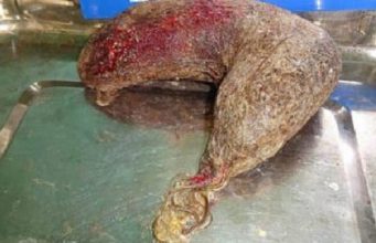 വയറില് ട്യൂമറെന്ന് കരുതി ശസ്ത്രക്രിയ; ഓപ്പറേഷന് തിയേറ്ററില് ഞെട്ടിത്തരിച്ച് ഡോക്ടര്മാര്