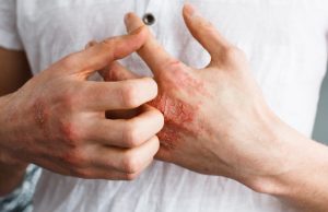 കാരണം കണ്ടെത്തി നിയന്ത്രിക്കാം, ഇതാണ് എക്സിമ തടയാനുള്ള വഴി: ഡോക്ടറുടെ കുറിപ്പ് വായിക്കാം