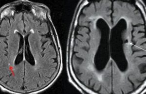 സൈലന്റ് സ്ട്രോക്ക് തിരിച്ചറിയാം ലക്ഷണങ്ങളിലൂടെ