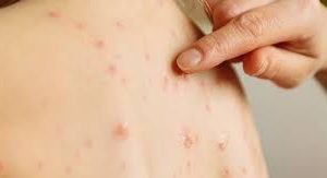 ലോകത്താകമാനം അഞ്ചാംപനി പൊട്ടിപുറപ്പെടുമെന്ന് സൂചന; മുന്നറിയിപ്പ്