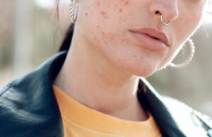 മുഖക്കുരു പതിവായി വരുന്നുണ്ടോ?: വയറിന് പ്രശ്നമുണ്ടാകാം