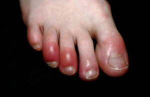 കാൽവിരൽ ചുവന്ന് തടിക്കുന്നു; എന്താണ് കോവിഡ് ടോ?