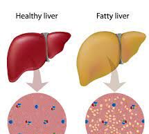 ഫാറ്റിലിവര് വരാതിരിക്കാന് ശ്രദ്ധിക്കേണ്ട കാര്യങ്ങള്