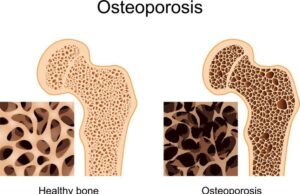 അസ്ഥിക്ഷയത്തെ ശ്രദ്ധിക്കാം