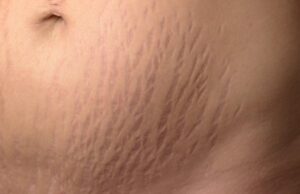 പ്രസവശേഷമുള്ള സ്ട്രച്ച് മാര്ക്കുകള് മാറും; ചില മാര്ഗങ്ങള് പരീക്ഷിക്കാം