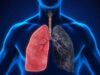 ശ്വാസം മുട്ടലുണ്ടെങ്കില് സൂക്ഷിക്കുക; ദീര്ഘകാല കോവിഡ് രോഗികളില് ശ്വാസകോശത്തിന് ക്ഷതം