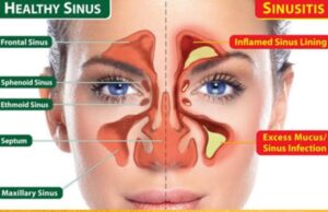 സൈനസൈറ്റിസ് അറിയേണ്ടതെല്ലാം