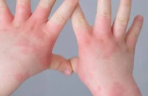 സംസ്ഥാനത്ത് തക്കാളി പനിപടരുന്നു.