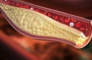 കൊളസ്ട്രോള് . അറിയേണ്ടതെ ല്ലാം ?