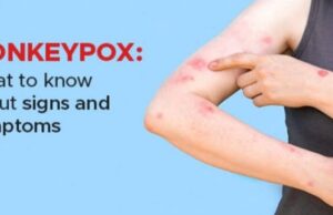 വാനര വസൂരി ലക്ഷണങ്ങൾ ഇവയെല്ലാം