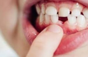 കുഞ്ഞുങ്ങളുടെ ദന്തസംരക്ഷണം എങ്ങനെ?